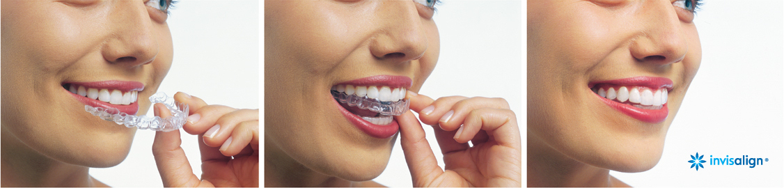 Redwood City Invisalign Services